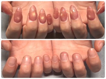 ネイルアンドアイラッシュ シシュ 高槻店(nail&eyelash SyiSyu)の写真/パラジェル登録店【深爪矯正コース¥6600】爪を噛んでしまう癖・ちぎる癖で爪が伸ばせない深爪を改善
