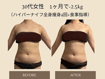 オベリオ(OBERIO)/ハイパーナイフ全身痩身