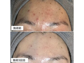 ルイス(LOUIS)の写真/肌質改善専門◇韓国最先端マシン×ピーリング肌管理で叶える☆肌質改善/美白ケア/水光肌/艶ハリUP♪