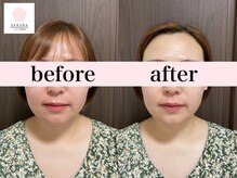 サクラ(SAKURA)/30歳美白透明感なら◎エアバリ