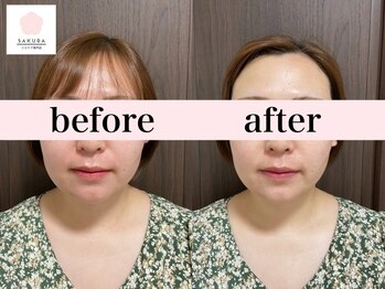 サクラ(SAKURA)/30歳美白透明感なら◎エアバリ