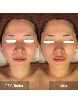 サンベリーナ(Thumbelina)/シンデレラケア