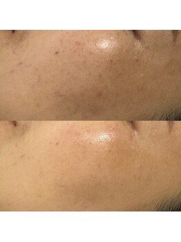 リフロ(Rifuro)/ララピール（症例写真）