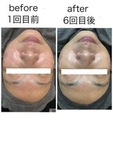 サロンドティアラ(Salon de Tiara)/シミケア(フォト)