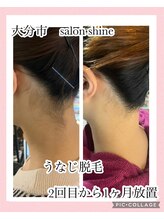 サロンシャイン(Salon Shine)/うなじ脱毛の効果