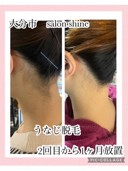 サロンシャイン(Salon Shine)/うなじ脱毛の効果