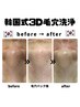 【韓国式3D毛穴洗浄】毛穴ケア・黒ずみ・ざらつき 15400円