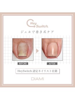 ネイルリテルナ(Nail Re.terna)/巻き爪ケア