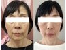 【たるみ＆二重アゴ改善！】リフトアップ小顔60分