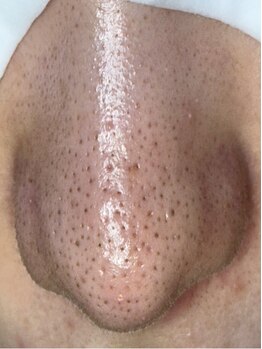 毛穴ケアをしたい