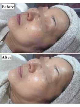 ソワナ(soina)/【神楽坂駅/フェイシャル/毛穴】