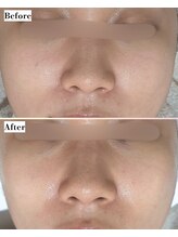 ソワナ(soina)/【神楽坂駅/フェイシャル/毛穴】