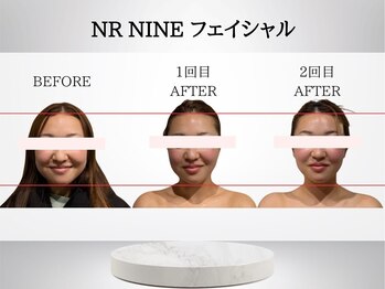 ジャパ(JAPA)/NRフェイシャルで超小顔!持続力