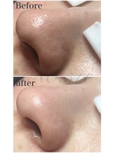 ナンバー511(No.511)/毛穴エクストラクション