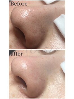 ナンバー511(No.511)/毛穴エクストラクション