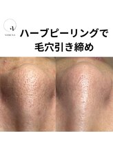 お顔そりローズマリー/ハーブピーリング