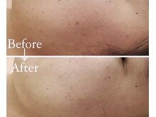 ボヌールデソワ(Bonheur de Soi)/ハーブピーリング