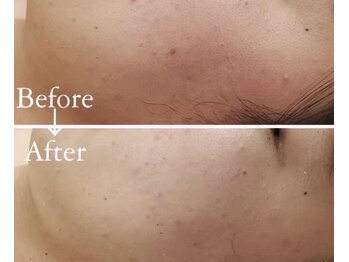 ボヌールデソワ(Bonheur de Soi)/ハーブピーリング