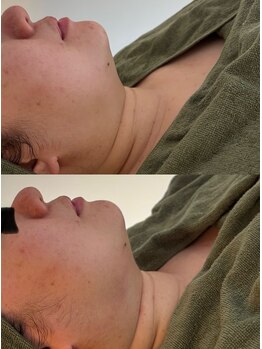 シーアイエステティック 船橋駅前店(c.iエステティック)/レモンボトル★ビフォーアフター