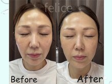 アイリー(IRIE)/ソフアールエフウェーブ