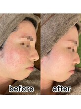 ドクターコガオ 福山店(Dr.小顔)/★ハーブピーリング10回の変化★