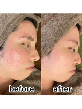 ドクターコガオ 福山店(Dr.小顔)/★ハーブピーリング10回の変化★