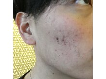 リコスタ 日本橋(RICOSTA)/リベルハーブピーリング