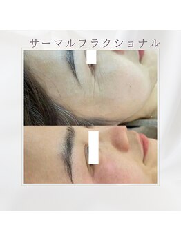 ミツレイ 九条店(MITUREI)/小顔サーマルフラクショナル☆