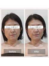 ディードットアン(D.an)/小顔コルギ