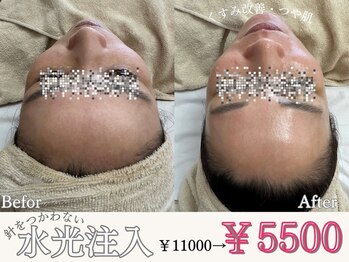 マヴィ くずは店(MavY.)/針を使わない水光注入!