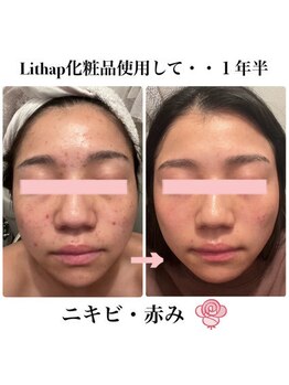 ケンビラク(Kenbiraku 健美楽)/ニキビ・赤み　1年半