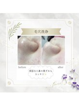 アディッシモ(addissimo)/毛穴の黒ずみもスッキリ☆