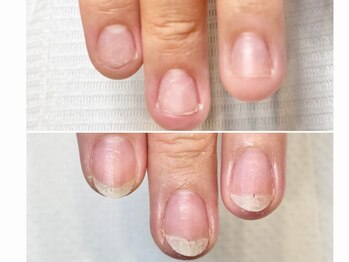 グラシュータン(gracieux temps)/深爪矯正