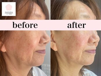 サクラ(SAKURA)/1回でこの変化です。積み上げUP