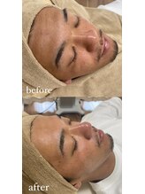 ミーミドットアイ(Mi-mi.i)/艶肌WAX脱毛