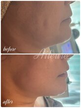 エルール トータルビューティ(Aileure total beauty)/インディバフェイシャル