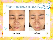 トータルセラピー リッチ(Rich)/50代　ほうれい線改善