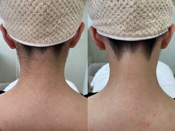 ソルシエール キレイ(ソルシエールkirei)/【人気のセット】お顔×うなじ