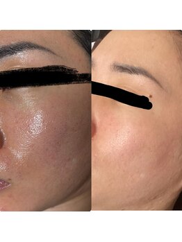 ミュー 新小岩店(Mieux)/毛穴洗浄