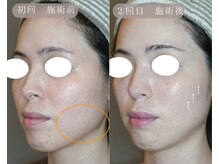 岩川治療院/食いしばりの改善により