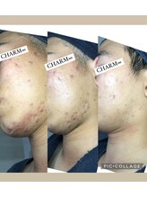 チャーム(CHARM∞)/メンズニキビケア