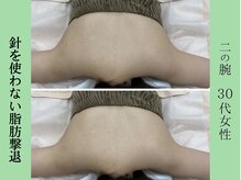 ソルニス(Solnis.)/痩身☆脂肪分解/ハイパーナイフ