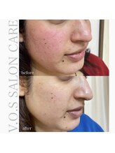 ルーナ(Runa)/■VOSサロンケア【ブラック】