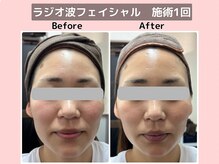 おにぎり(ONIGIRI)/★施術1回★