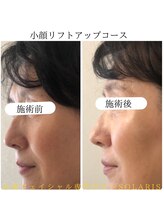 ソラリス(solaris)/小顔&毛穴