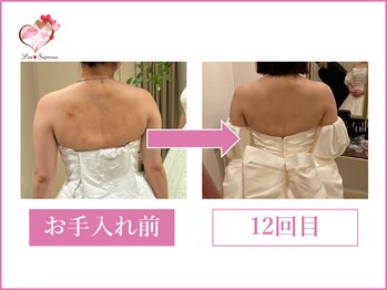 ディア スプリーマ/ブライダルエステ計14回