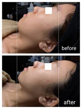 エクラ(eclat)/☆小顔フェイシャルエステ☆