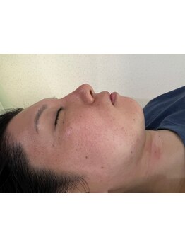 毛穴ケアをしたい