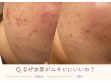 オートクチュール エステティックサロン シーズ/Q.なぜ水素がニキビにいいの？