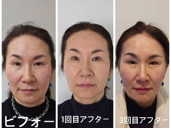 アクアナチュラ(ACQUANATURA)/続ける程効果が高まります!